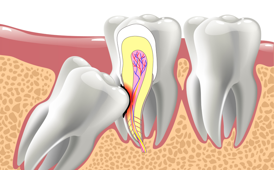 Extraction des dents de sagesse